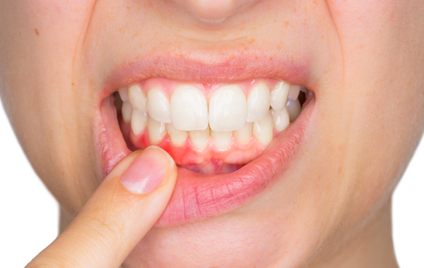 Gum disease prevention